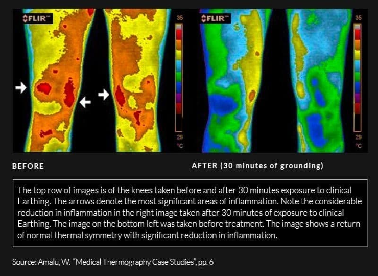 Before and after thermal imaging of knees with clinical earthing exposure